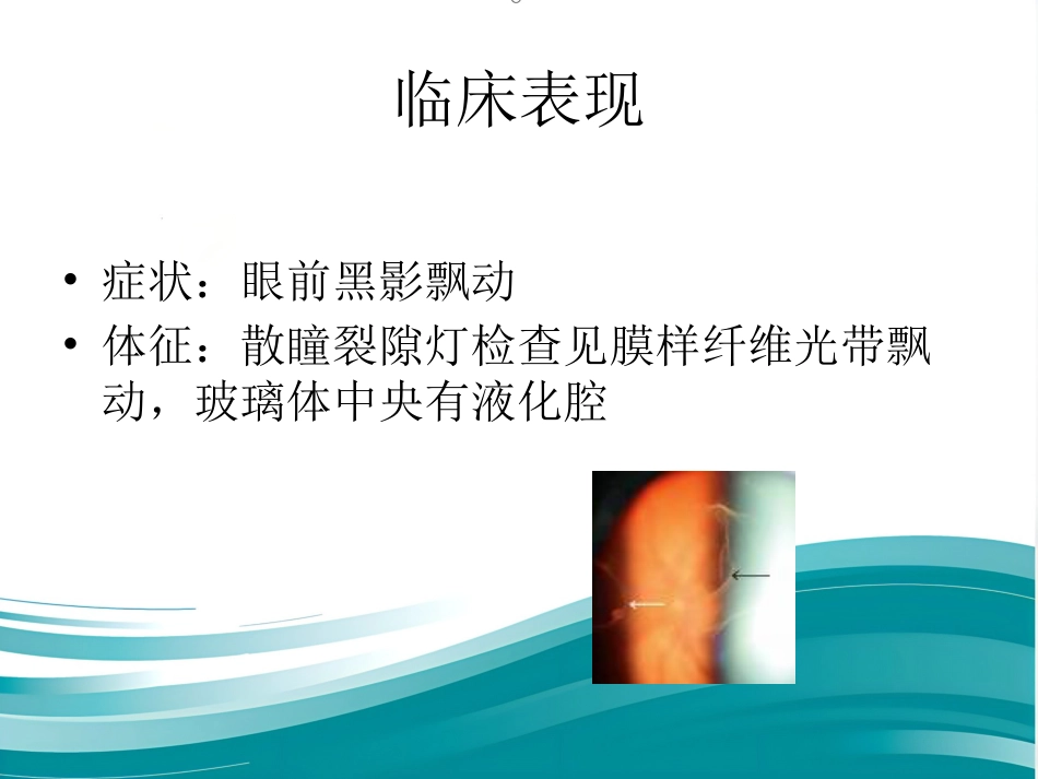 玻璃体和视网膜疾病_第3页