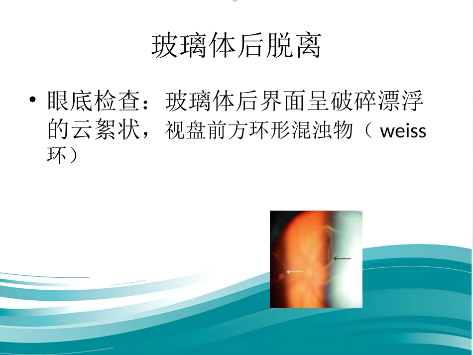 玻璃体和视网膜疾病_第5页