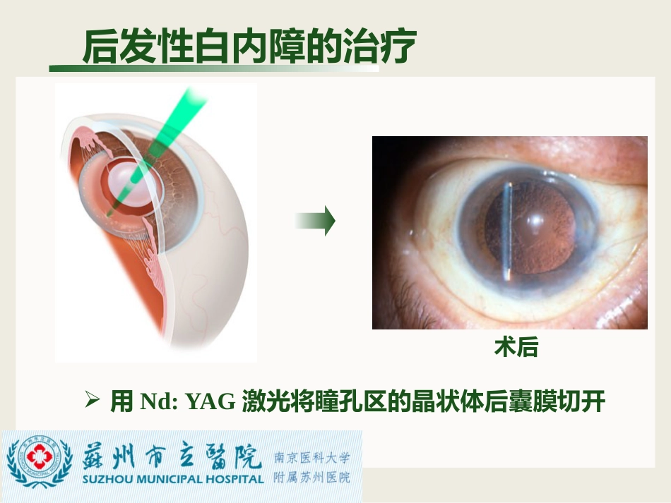白内障与青光眼与胬肉与糖网_第10页