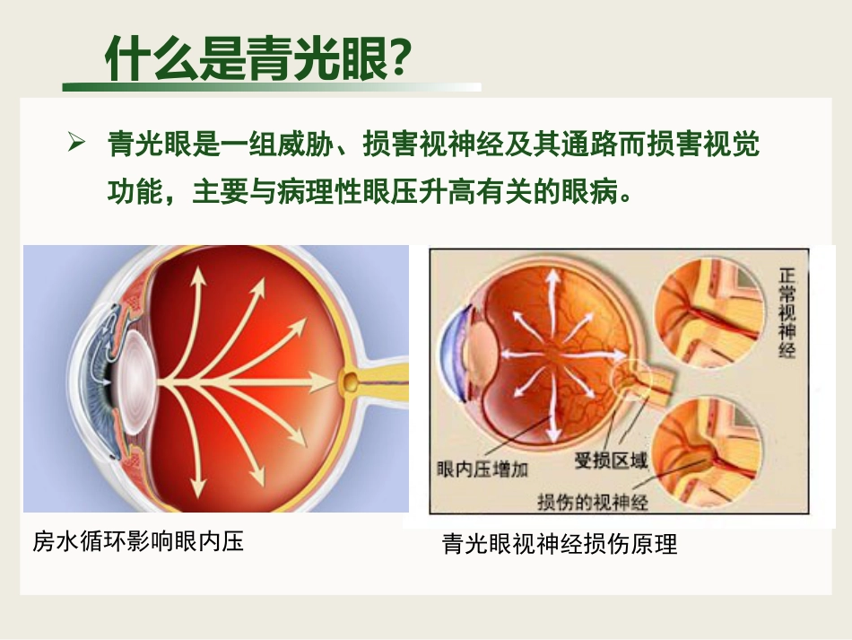 白内障与青光眼与胬肉与糖网_第12页