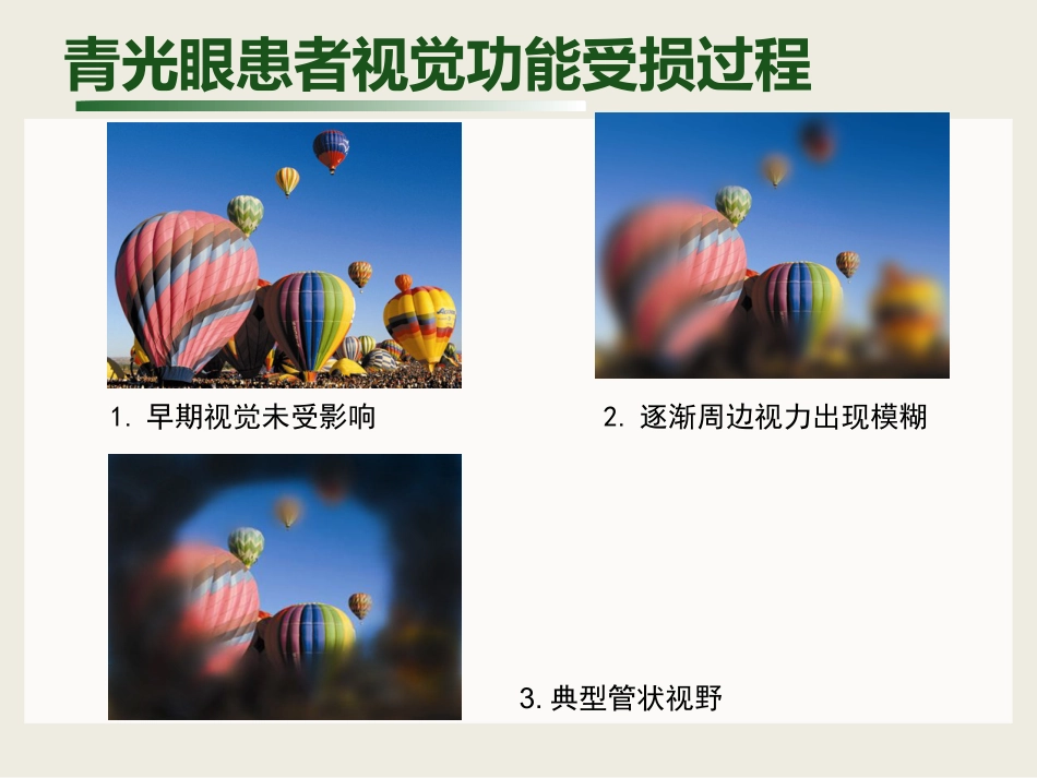 白内障与青光眼与胬肉与糖网_第14页