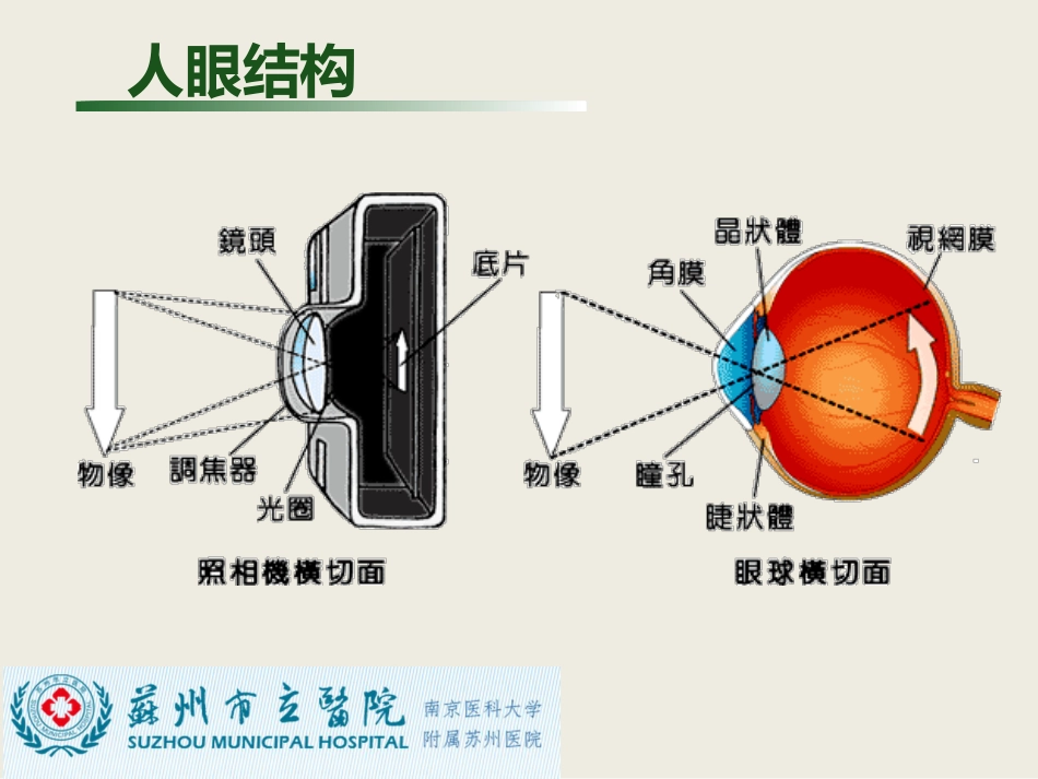 白内障与青光眼与胬肉与糖网_第3页