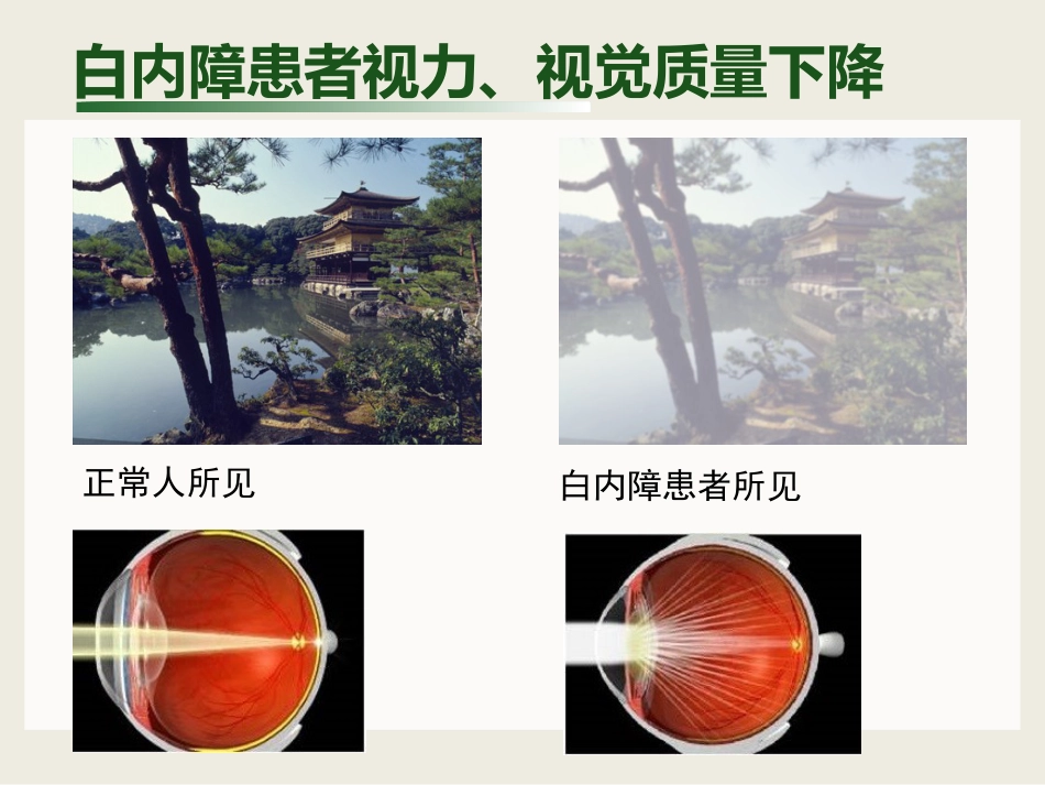 白内障与青光眼与胬肉与糖网_第5页
