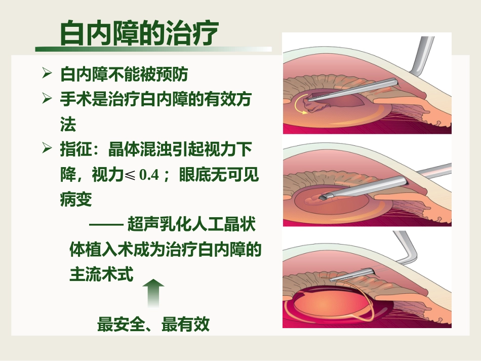 白内障与青光眼与胬肉与糖网_第6页