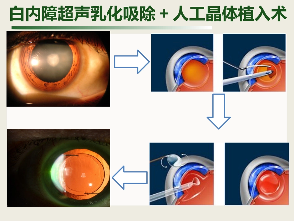 白内障与青光眼与胬肉与糖网_第7页