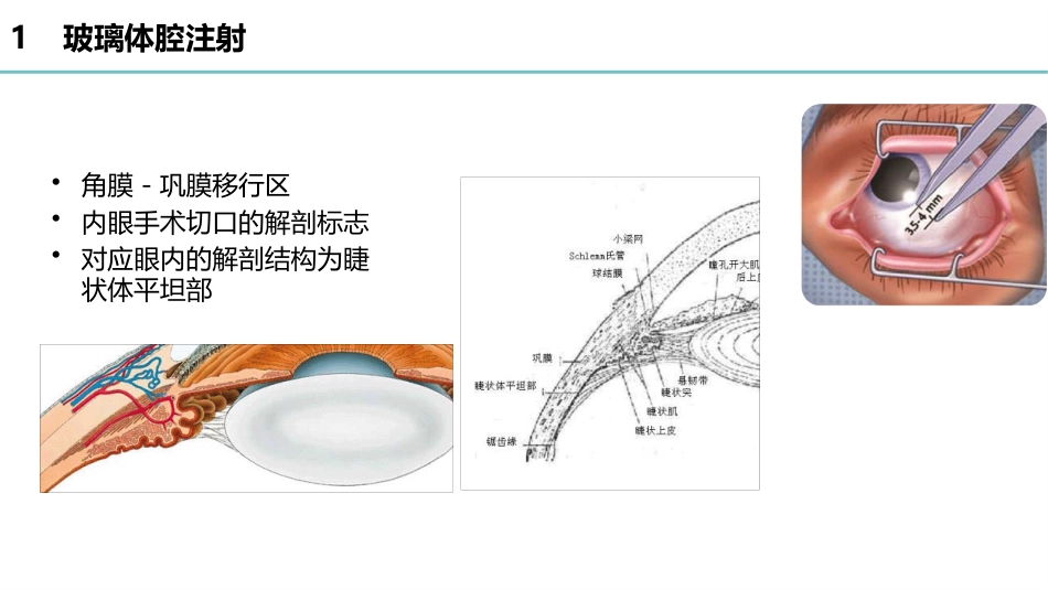 玻璃体腔注射标准操作流程-秦琼_第4页