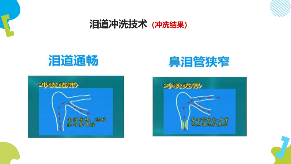泪道冲洗技术ppt_第7页