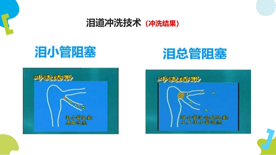泪道冲洗技术ppt_第8页