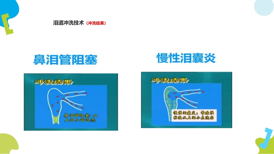 泪道冲洗技术ppt_第9页
