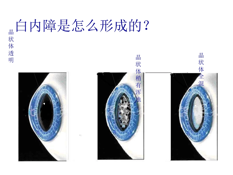 白内障玻璃体混浊_第3页