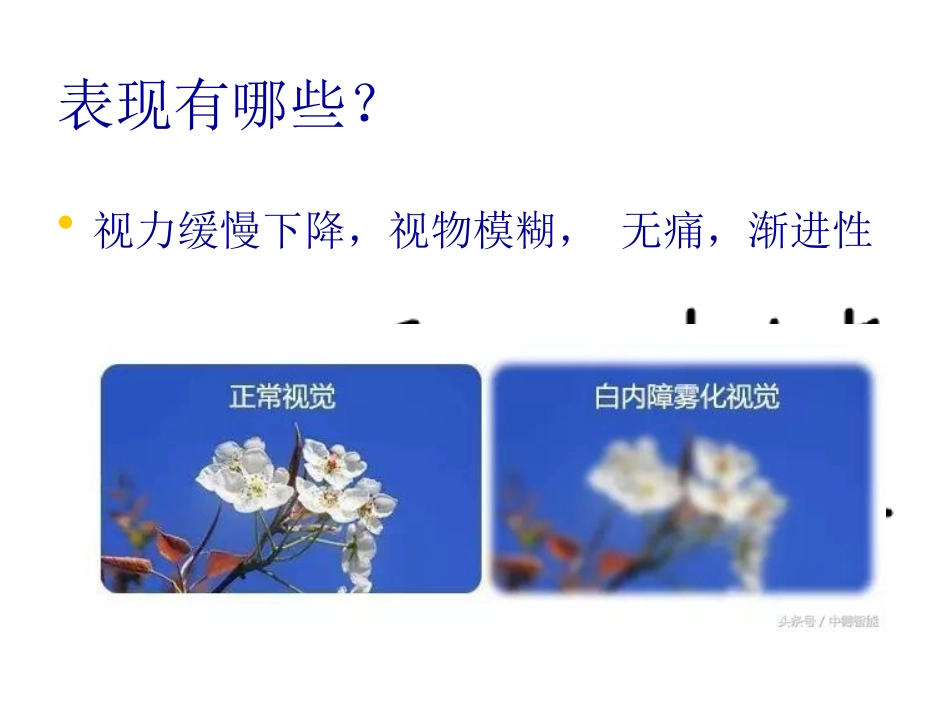 白内障玻璃体混浊_第5页