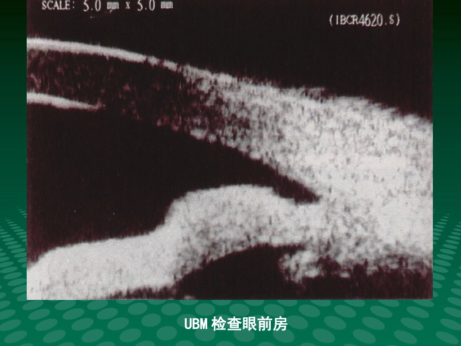 超声诊断学眼科疾病的超声诊断_第11页