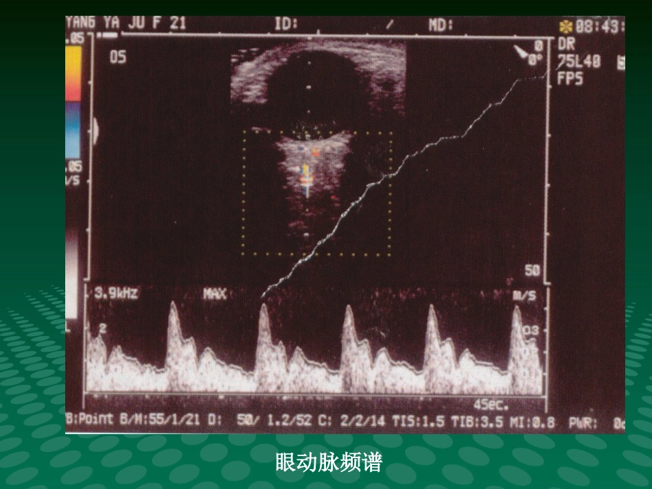 超声诊断学眼科疾病的超声诊断_第7页