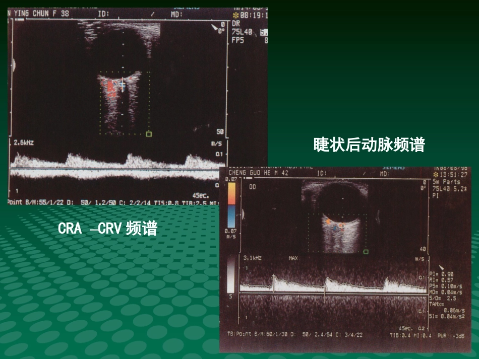 超声诊断学眼科疾病的超声诊断_第8页
