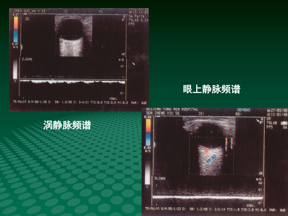 超声诊断学眼科疾病的超声诊断_第9页