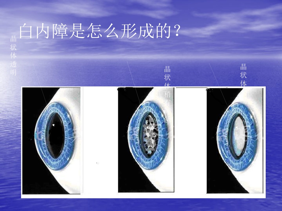 白内障 玻璃体混浊_第3页