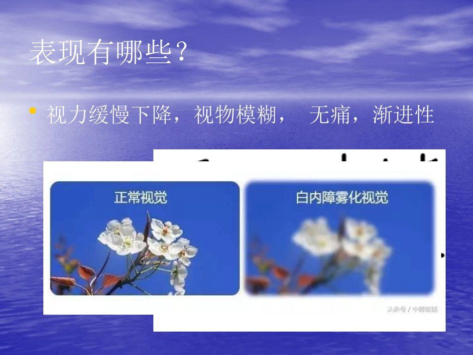 白内障 玻璃体混浊_第5页