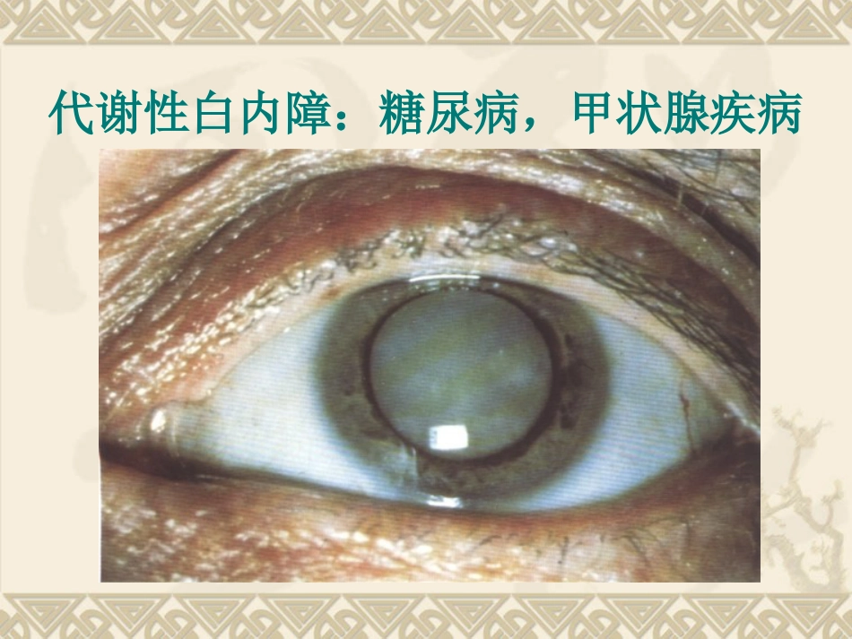 白内障患者护理_第10页