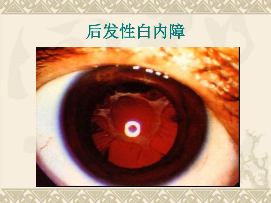 白内障患者护理_第11页