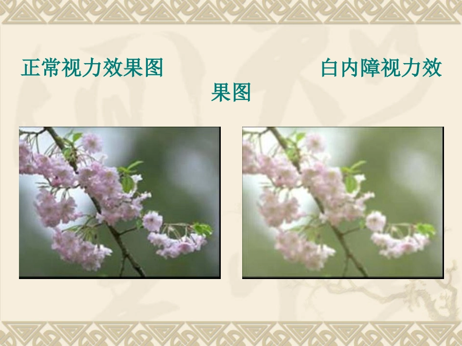 白内障患者护理_第13页