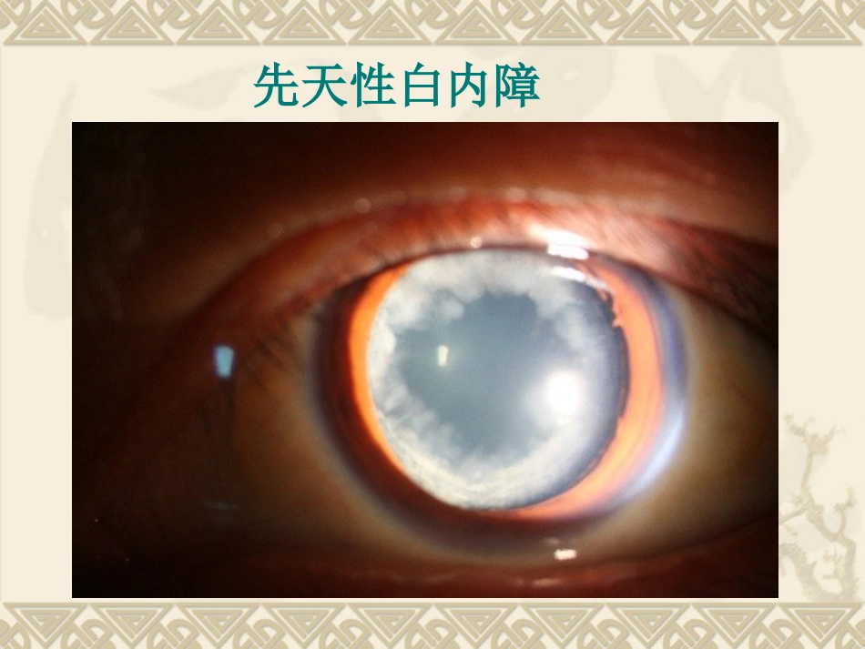 白内障患者护理_第7页