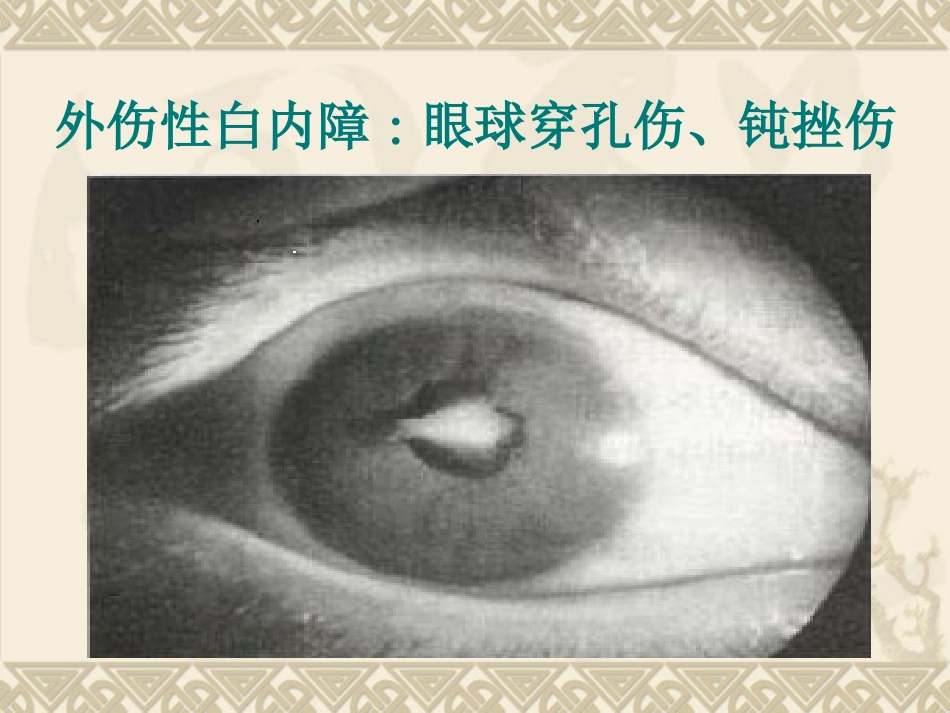 白内障患者护理_第8页
