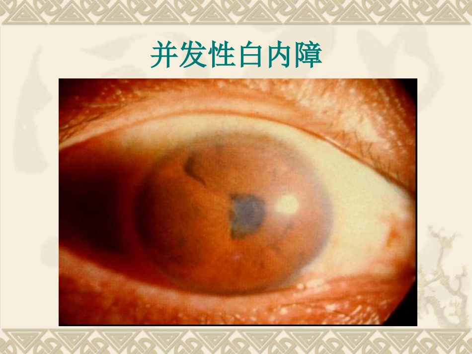 白内障患者护理_第9页