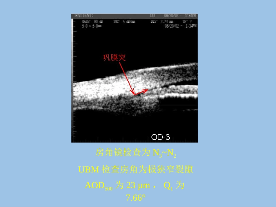 UBM在青光眼临床中应用_第10页