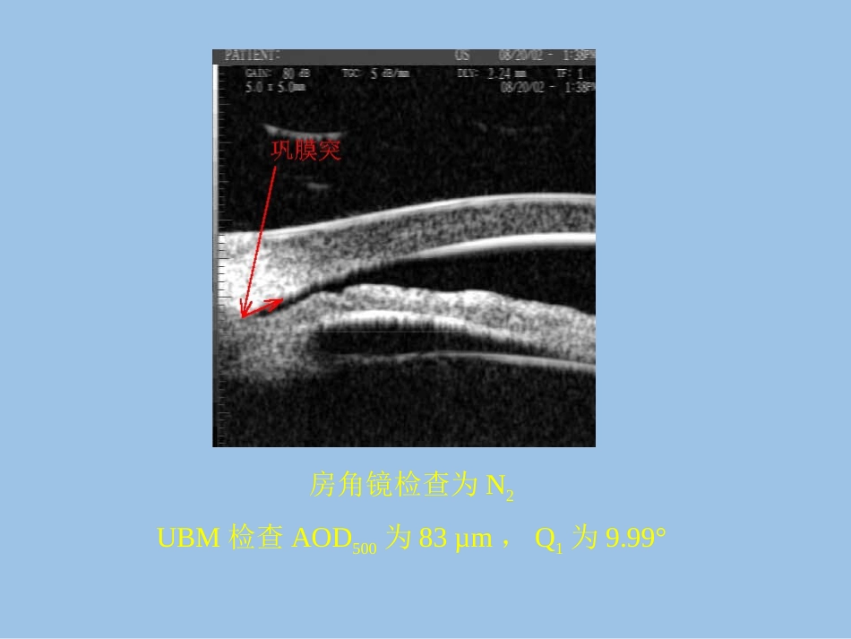 UBM在青光眼临床中应用_第11页