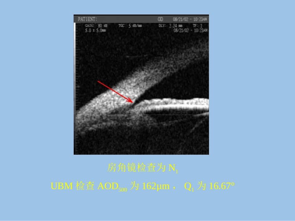 UBM在青光眼临床中应用_第12页