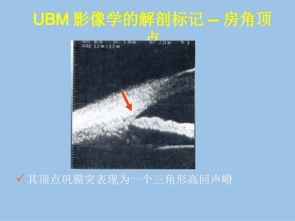 UBM在青光眼临床中应用_第3页