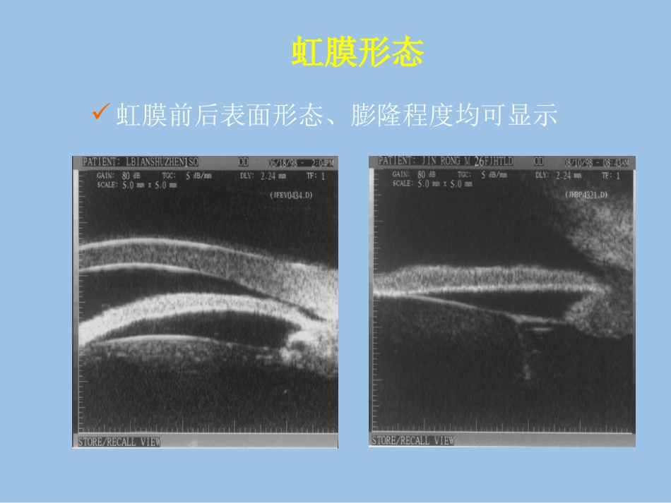 UBM在青光眼临床中应用_第6页