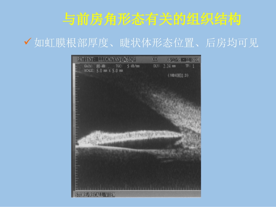 UBM在青光眼临床中应用_第7页