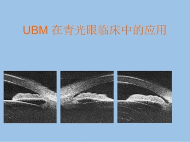 UBM在青光眼临床中应用