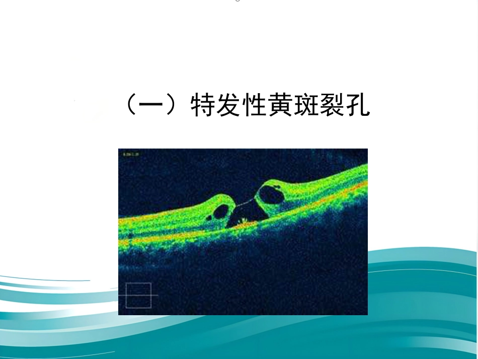 玻璃体黄斑交界面疾病——知识更新与进展-医学课件_第13页