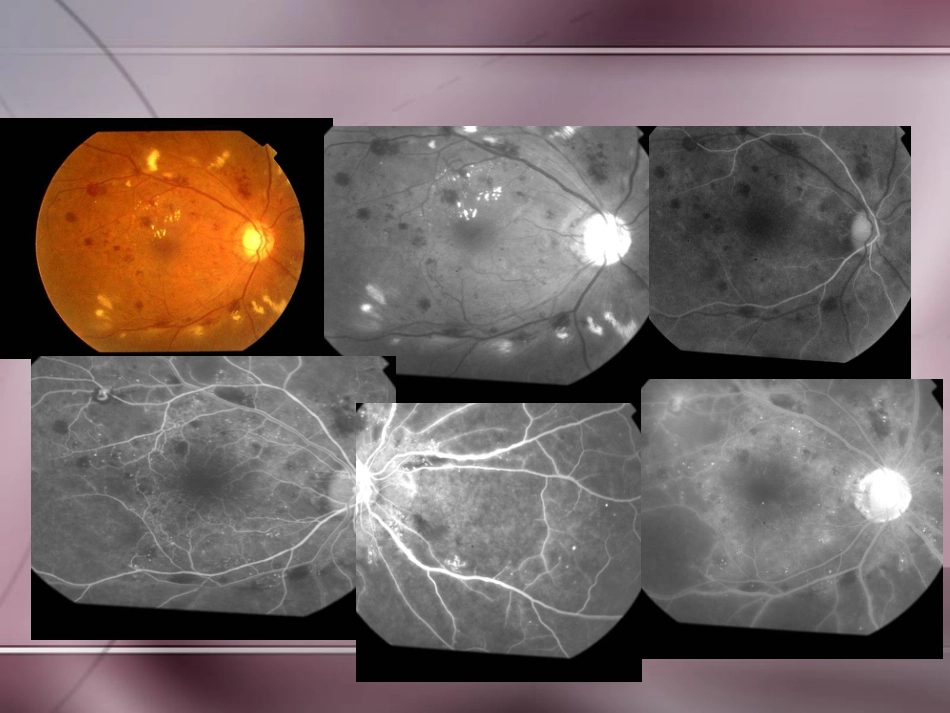 常见眼底病诊治_第13页