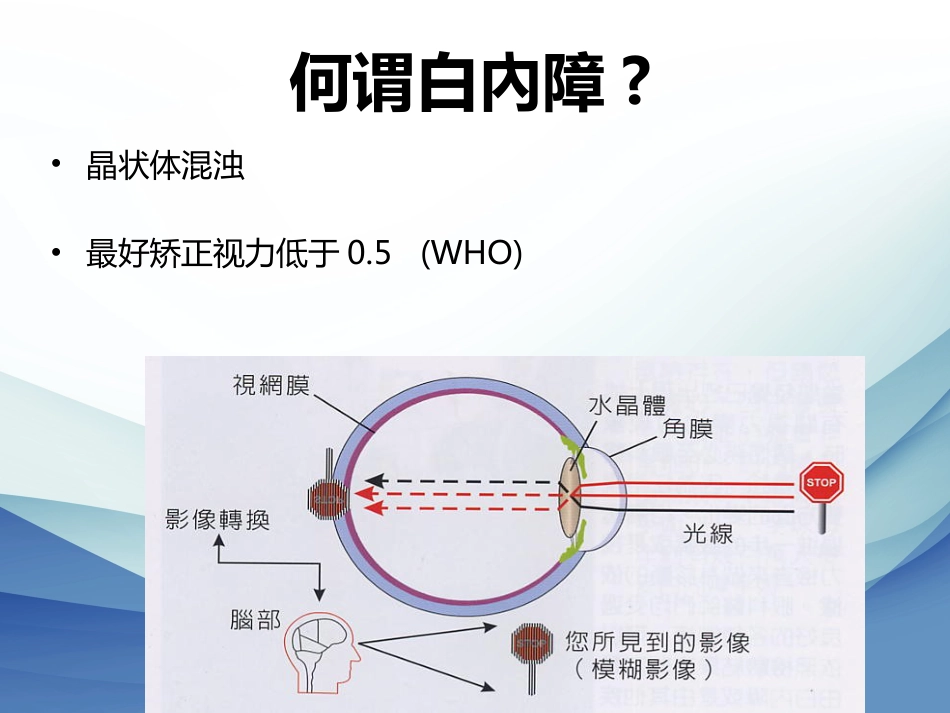 白内障成因及治疗_第5页
