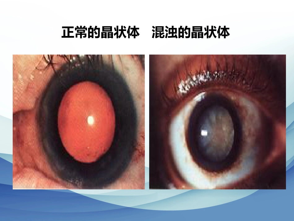 白内障成因及治疗_第6页