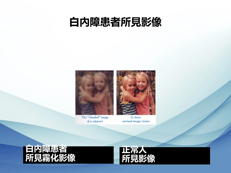 白内障成因及治疗_第8页