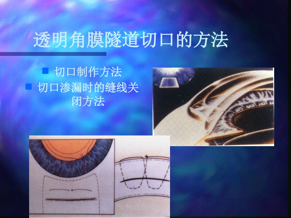 白内障超声乳化摘出术_第15页