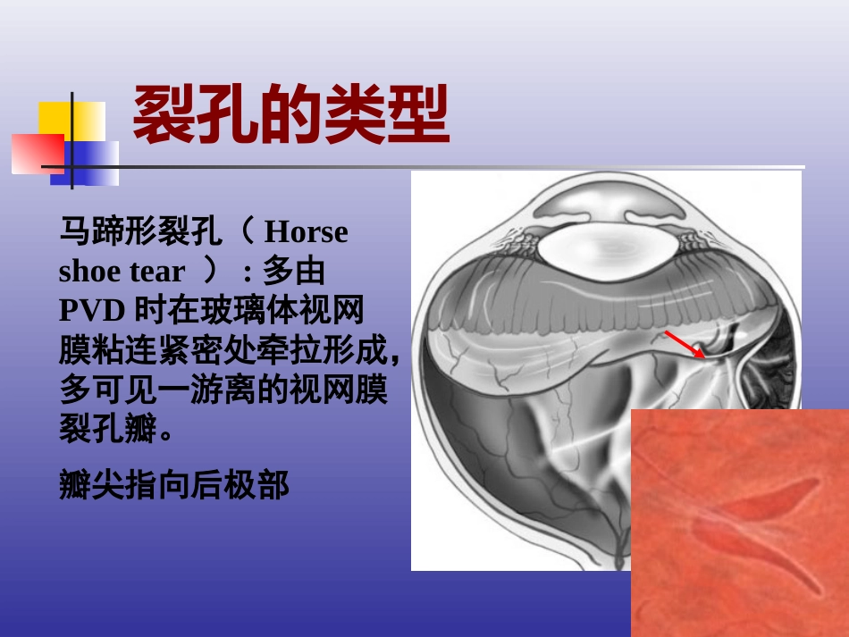 玻璃体后脱离、视网膜裂孔和格子样变性的诊断和治疗_第15页