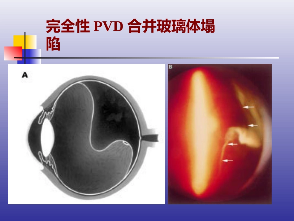 玻璃体后脱离、视网膜裂孔和格子样变性的诊断和治疗_第7页