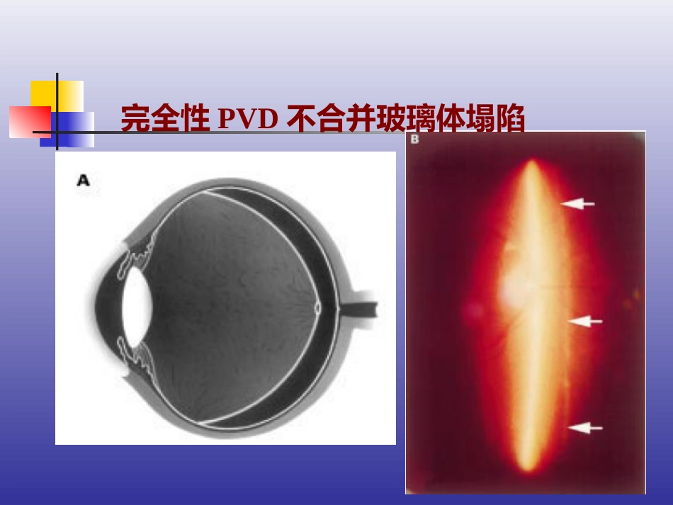 玻璃体后脱离、视网膜裂孔和格子样变性的诊断和治疗_第8页