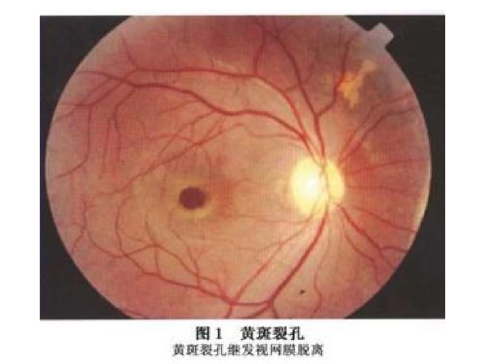玻璃体切割术后_第10页