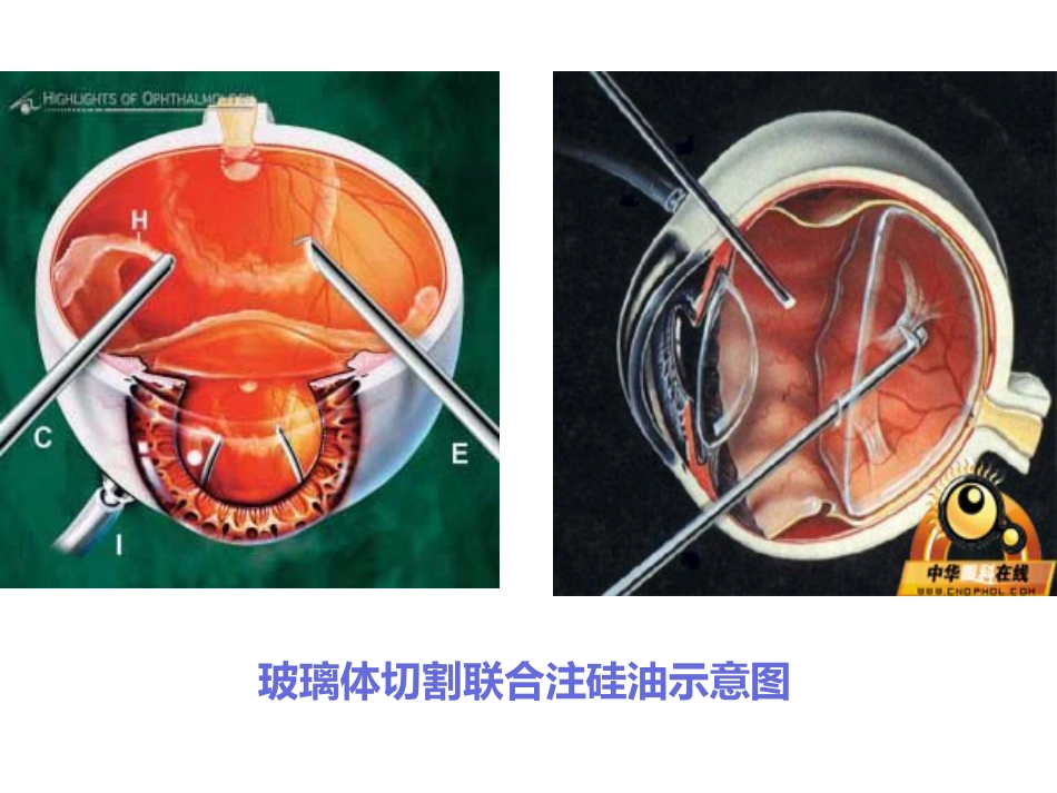 玻璃体切割术后_第5页