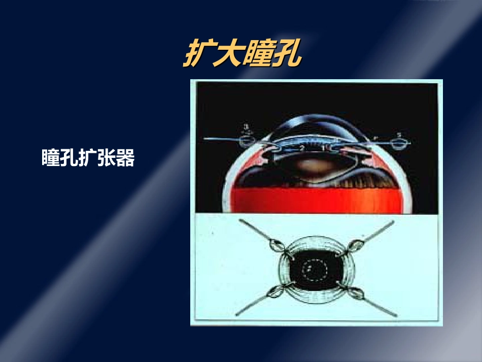 白内障并发症及其处理ppt课件_第10页