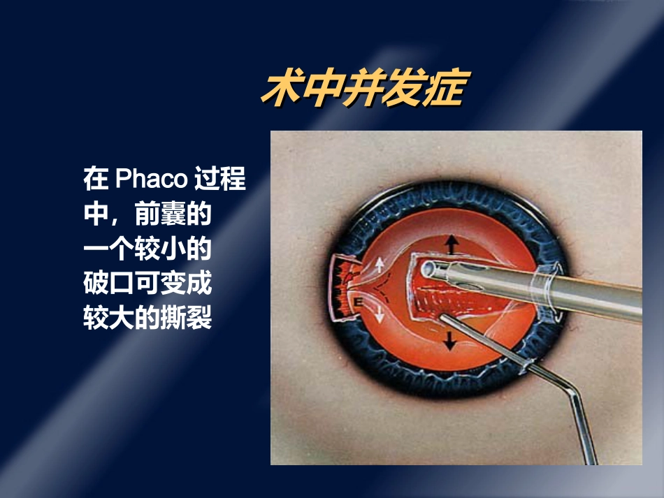 白内障并发症及其处理ppt课件_第15页