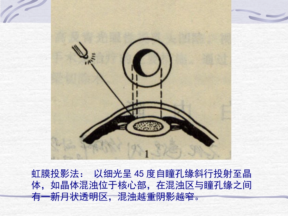白内障青光眼护理_第10页