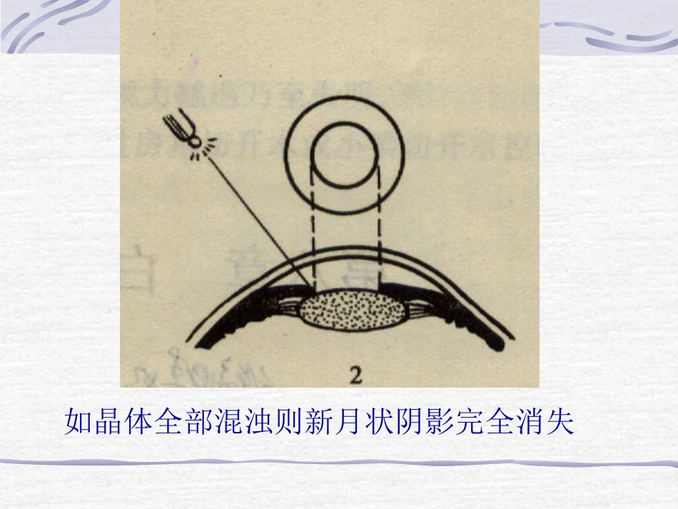 白内障青光眼护理_第11页