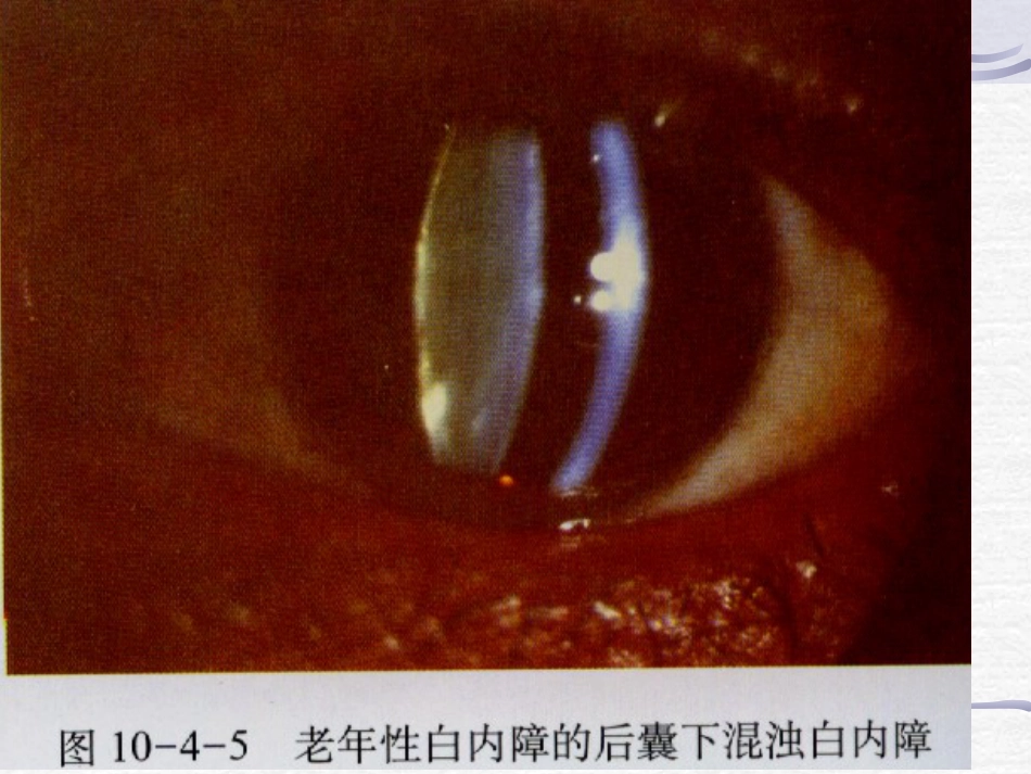 白内障青光眼护理_第15页